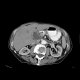 Hepatocellular carcinoma - 3 phase CT scans: CT - Computed tomography